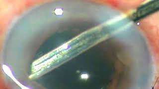 Anterior Chamber reconstruction  Iris bombe 360 posterior Synechia [upl. by Standice165]