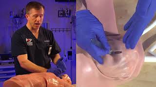 Emergency Bougie Cricothyrotomy Procedure Explained [upl. by Aihpos220]