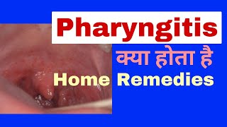 Pharyngitis क्या होता हैकैसे ठीक होगा  Gate me infection ke lakshan  sore throat in hindi [upl. by Jc]