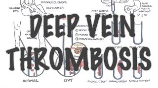 Deep Vein Thrombosis  Overview pathophysiology treatment complications [upl. by Vine]