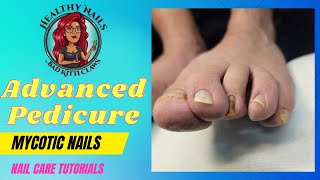 How to care for Mycotic Pincer Nails [upl. by Reichert]