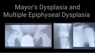 Mayors Dysplasia and Multiple Epiphyseal Dysplasia Radiology anx Xrays findings [upl. by Sukhum]