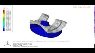 Prosthetic knee joint articulation [upl. by Margetts818]