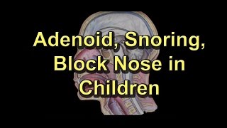 Adenoiditis Adenoid Surgery Snoring Block noseRunny nose in children [upl. by Haveman]