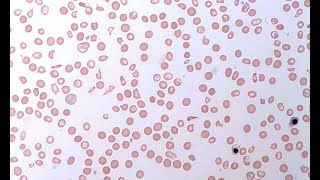 Pegcetacoplan un tratamiento prometedor para pacientes con hemoglobinuria paroxística nocturna [upl. by Evreh]