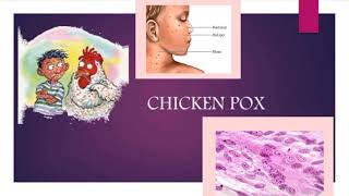 CHICKENPOX  Definition of chickenpox  Symptoms of chickenpox💯 [upl. by Corbie]