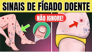 10 SINAIS de PROBLEMA no FÍGADO na PELE  Sintomas de GORDURA NO FÍGADO CIRROSE e HEPATITE [upl. by Yewed]