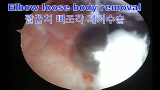 Arthroscopic Removal of Osteochondritis Dissecans Loose Body in the Elbow 팔꿈치 관절에서 뼈조각 제거를 위한 관절경 수술 [upl. by Naol390]