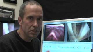 Laryngology 101 What is vocal cord paralysis Part 2 of 2 [upl. by Kakalina392]