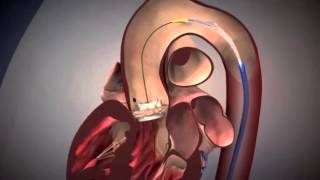 Advancing Aortic Stenosis Treatment Using TAVR with Dr Alan Malki [upl. by Tri923]