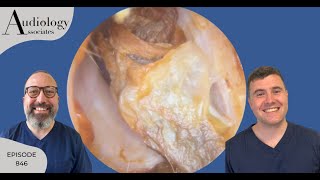 ITCHY EAR CANALS FIXED amp ANTERIOR RECESS EAR WAX REMOVAL  EP846 [upl. by Sivrad]