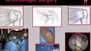 Rotator Cuff Tear Diagnosis amp Treatment [upl. by Jami558]