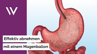 Wie einfach der Weight Doctors® Magenballon funktioniert Schonend effektiv umkehrbar [upl. by Namdor]