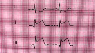 infarctus aigu et inferieur du myocarde [upl. by Ribaj]