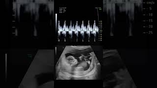 This is What a Babys Heartbeat Sounds Like During an Ultrasound science natal shorts [upl. by Nivat253]