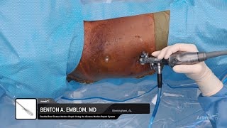 Endoscopic DoubleRow Gluteus Medius Repair Using the Gluteus Medius Repair System [upl. by Jabon]