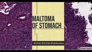 MALToma stomach1 [upl. by Nilreb94]