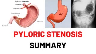 PYLORIC STENOSIS SUMMARY Causes Symptoms Signs Diagnosis Hypertrophic Pyloric Stenosis Lecture [upl. by Clarey]