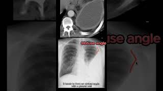 Empyema vs Pleural Effusion vs Lung Abscess radiology radiologystudent medicalstudent [upl. by Vada]