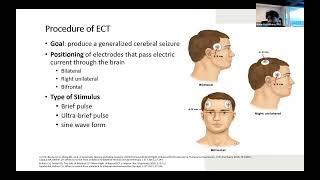 quotReview of Electroconvulsive Therapyquot  Kenn Vattathara MD PGY3  03012024 [upl. by Ettenuahs]