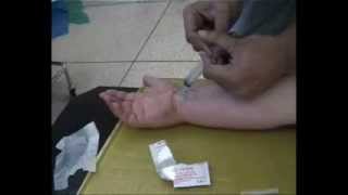 Problem with steroid shots for carpal tunnel syndrome [upl. by Eyahsal]