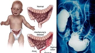 Maladie de Hirschsprung du nourrisson  maladie  chirurgie  animation 3D [upl. by Htez]