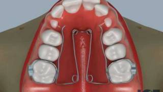 Quad Helix Appliance Part 2 [upl. by Etnuad]