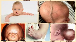 10 COMMON BIRTH DEFECTS  GENETIC DEFECTS IN PREGNANCY  WHAT ARE BIRTH DEFECTS [upl. by Ibrek]