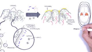 Adenoids Enlargement  Cure Without Operation  Most Common in Children [upl. by Bronson]