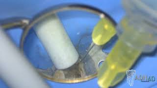 Retraitement endodontique de 16 avec recherche du MV2 au microscope [upl. by Mccarty982]