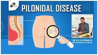 Pilonidal Sinus Disease  Causes Symptoms and Treatments  Dr K S S Gopinath  Havish Media [upl. by Atiker]