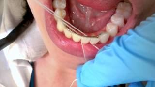 Flossing a Lingual Bar Trick [upl. by Ravaj]