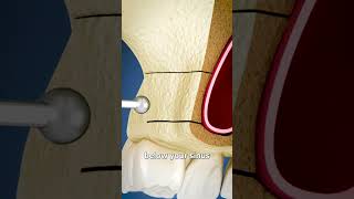 Sinus Lift Surgery Explained 🤔 [upl. by Freberg184]