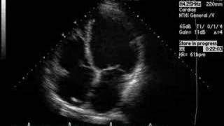 Dilated Cardiomyopathy [upl. by Cockburn]