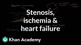 Stenosis ischemia and heart failure  Miscellaneous  Heatlh amp Medicine  Khan Academy [upl. by Cerys324]