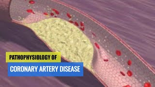 Pathophysiology of Coronary Artery Disease amp ACS Motion Animation [upl. by Jemine]