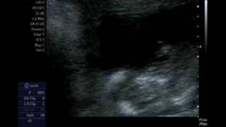 Our Pregnancy 12 weeks 5 days  Nuchal fold scan [upl. by Ttegirb29]