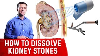 How To Dissolve Kidney Stones Explained By DrBerg [upl. by Stoddard54]