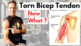 Torn or Ruptured Bicep Tendon What you need to know [upl. by Gniy224]