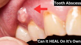 Can A Tooth Abscess HEAL On Its OWN  Find Out the Truth [upl. by Vharat519]