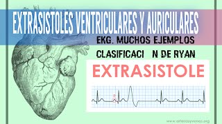 cardiología  EXTRASISTOLES VENTRICULARES Y AURICULARES CLASIFICACION DE RYAN medicina [upl. by Amara506]