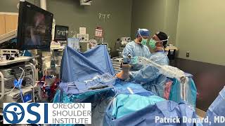 How Will I Be Positioned During Shoulder Arthroscopy [upl. by Attirehs849]