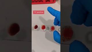 quotOquot positive blood type blood bloodgroup bloodtype bloodtyping laboratory [upl. by Trisha]