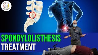 Spondylolisthesis Treatment [upl. by Ttekcirc]