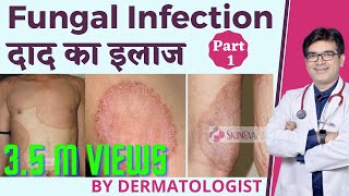 Fungal Infection Treatment In Hindi  फ़ंगल इन्फ़ेक्शन का इलाज हिंदी में  Dermatologist  Dr Sunil [upl. by Royd]