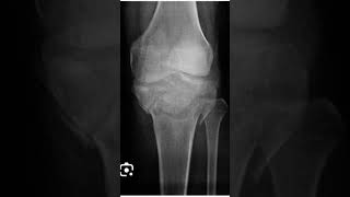 tibia bone fracture and after plating reducedlikeshareandsubscribadvance hospitaldoctor [upl. by Llerat92]