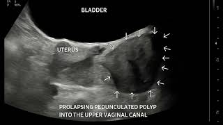 Gynaecology Ultrasound Quiz 1  2 Interesting cases [upl. by Runkle]