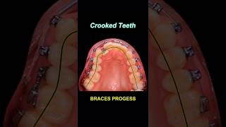 If your teeth are crooked brcaes can help braces orthodontist dentist [upl. by Nirol]