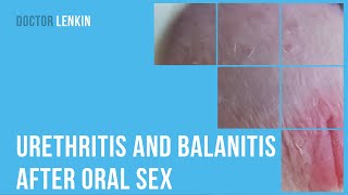 ▶ Urethritis and balanitis after oral sex [upl. by Yllet195]