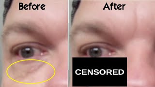 How Use Trichloroacetic Acid on Xanthelasma Spots Around Eyes at Home WARNING My BAD Experience TCA [upl. by Einreb]